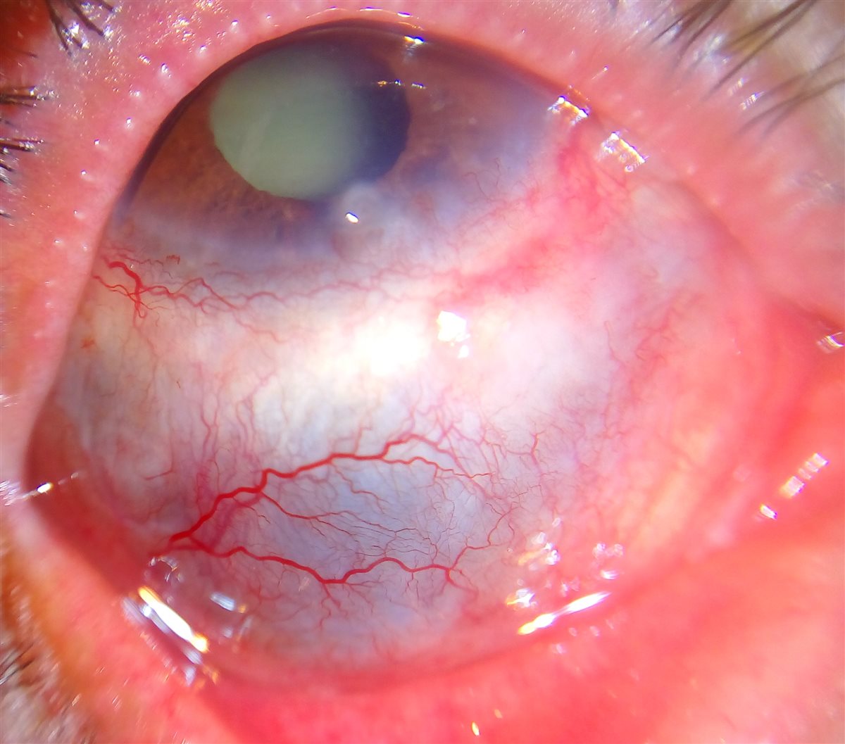 Scleritis: bluish-gray scleral thinning and translucency from recurrent inflammation, with engorged, tortuous deep episcleral vessels