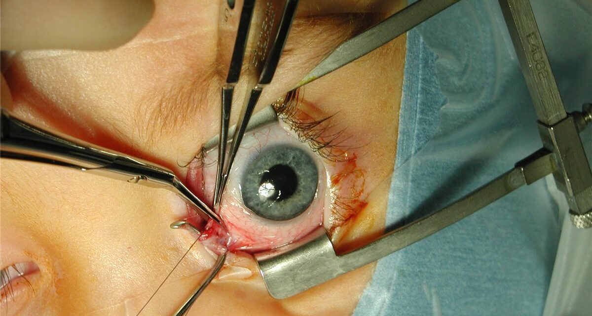 Strabismus Surgery: The Mechanics Behind Recession and Resection