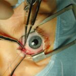 Strabismus surgery: an intraoperative view showing disinsertion of an extraocular muscle with a traction suture in place, viewed through a lid speculum during recession-resection surgery
