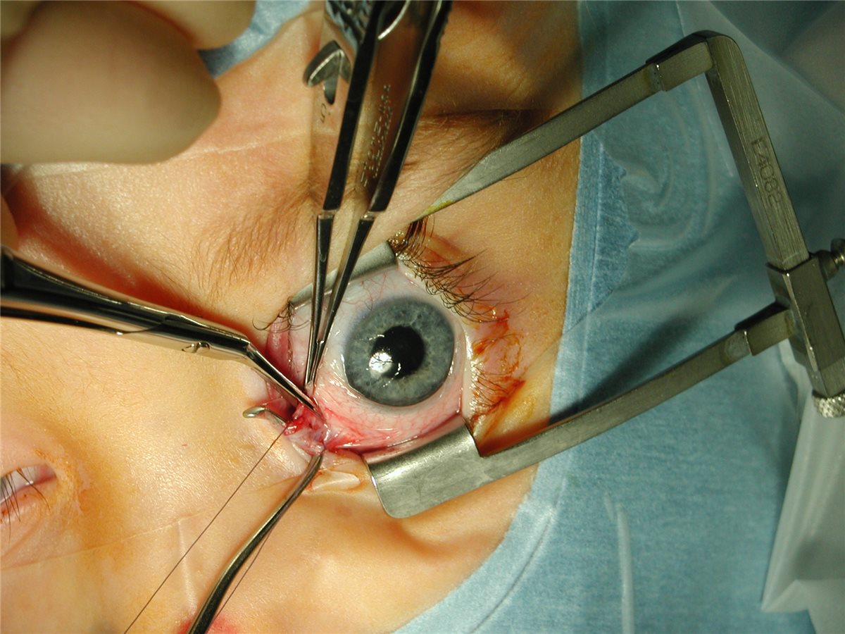 Strabismus surgery: an intraoperative view showing disinsertion of an extraocular muscle with a traction suture in place, viewed through a lid speculum during recession-resection surgery
