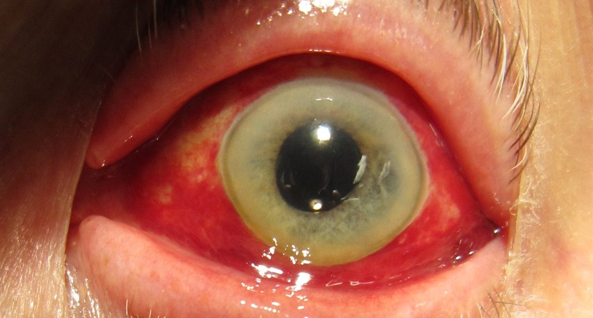 Subconjunctival Hemorrhage: Alarming to Look At, Almost Always Benign