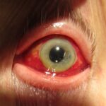 Subconjunctival hemorrhage: diffuse, bright red blood confined beneath the bulbar conjunctiva with a clear cornea and normal-appearing iris and pupil