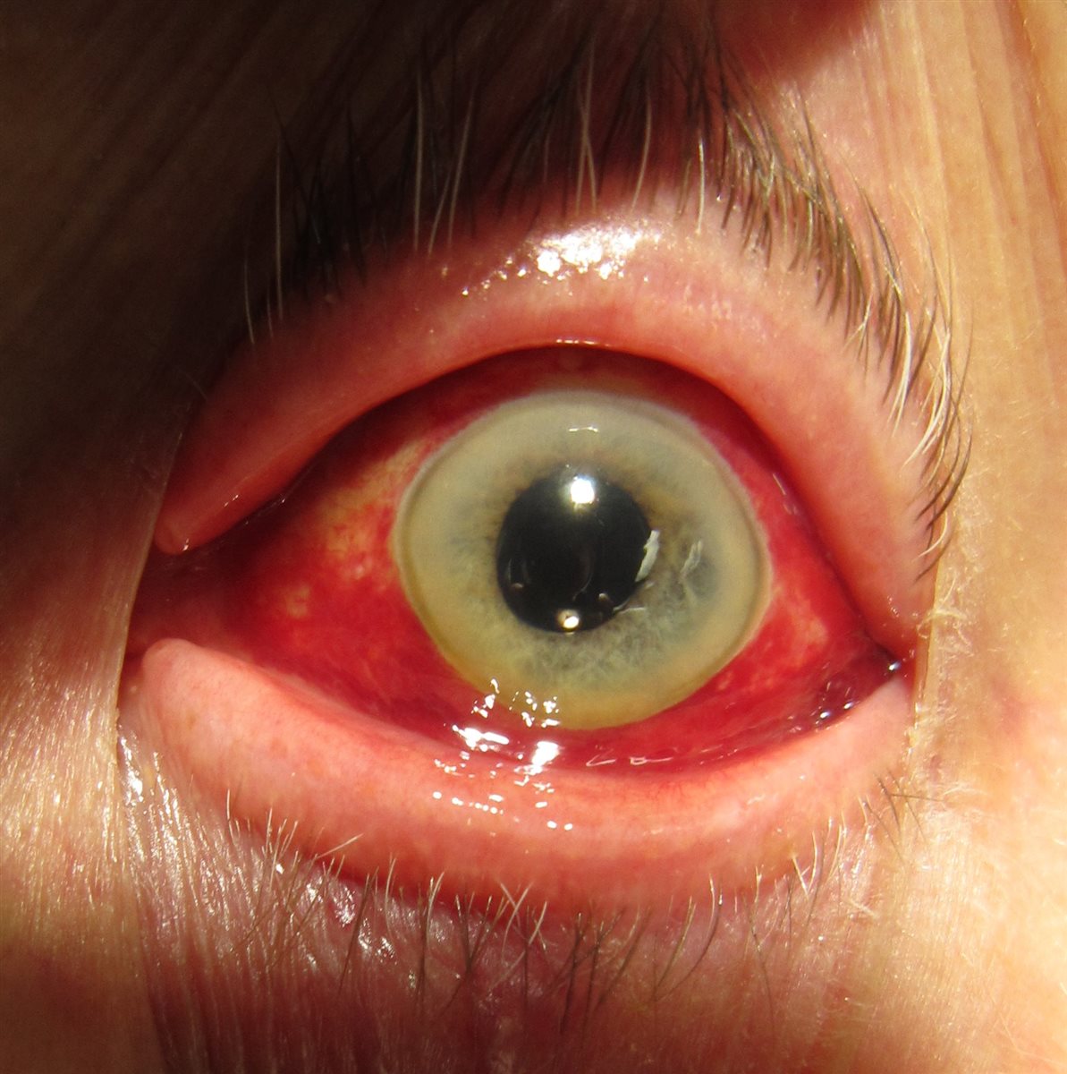 Subconjunctival hemorrhage: diffuse, bright red blood confined beneath the bulbar conjunctiva with a clear cornea and normal-appearing iris and pupil