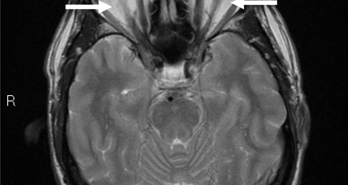 Thyroid Eye Disease: Why It’s Not Always About the Thyroid Numbers