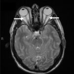 Thyroid eye disease (Graves ophthalmopathy): axial MRI showing bilateral proptosis with enlarged, congested extraocular muscles at the orbital apex, indicated by arrows