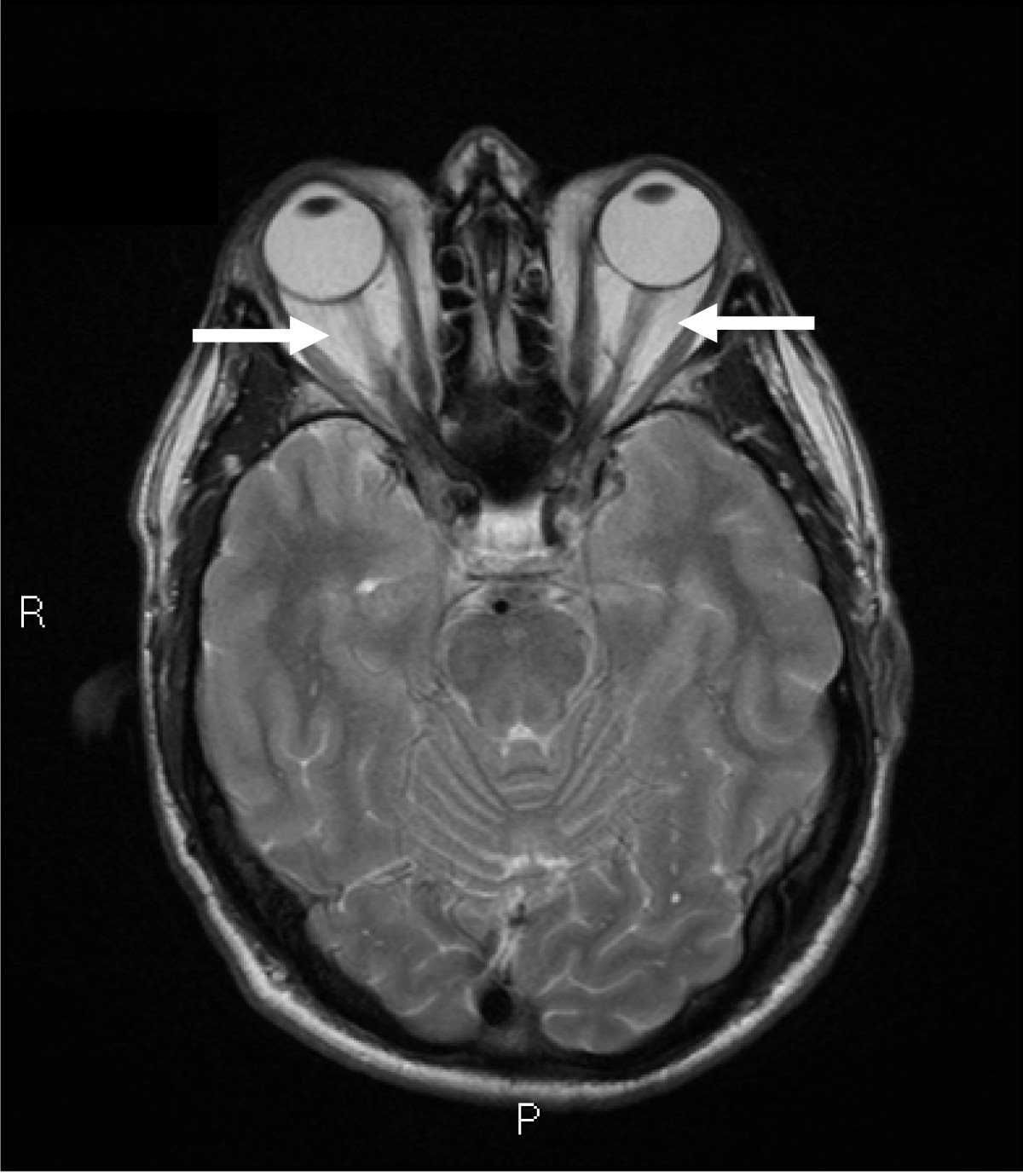 Thyroid eye disease (Graves ophthalmopathy): axial MRI showing bilateral proptosis with enlarged, congested extraocular muscles at the orbital apex, indicated by arrows