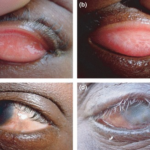 Trachoma: four clinical stages showing (a) follicular and papillary inflammation of the upper tarsal conjunctiva, (b) tarsal conjunctival scarring, (c) entropion with trichiasis, and (d) corneal opacification with entropion and trichiasis