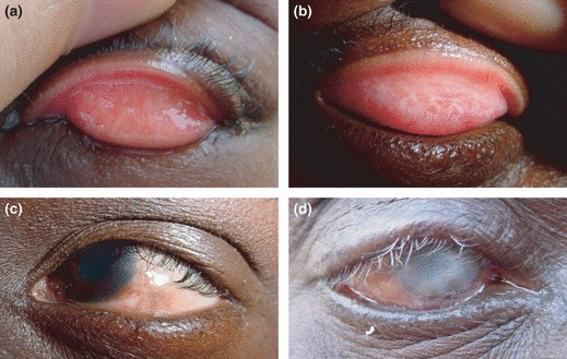 Trachoma: When Repeated Infection Turns Lashes Into the Enemy
