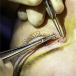 Upper eyelid blepharoplasty: an intraoperative close-up showing suture closure of the upper eyelid skin incision after excision of redundant skin and orbital fat