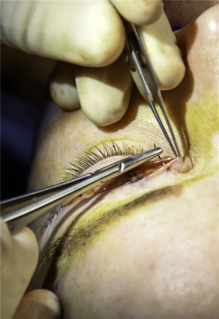 Upper eyelid blepharoplasty: an intraoperative close-up showing suture closure of the upper eyelid skin incision after excision of redundant skin and orbital fat