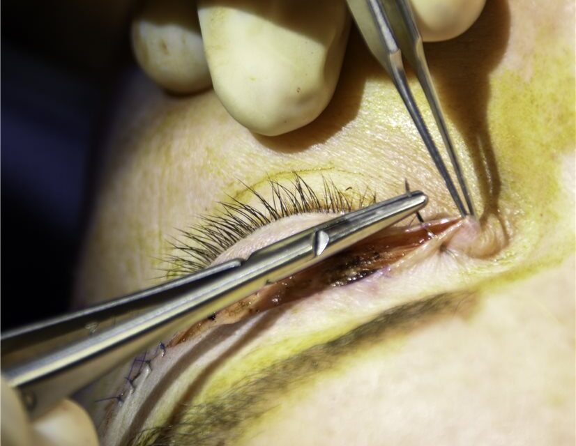 Upper Eyelid Blepharoplasty: Where Cosmetic Ends and Functional Begins