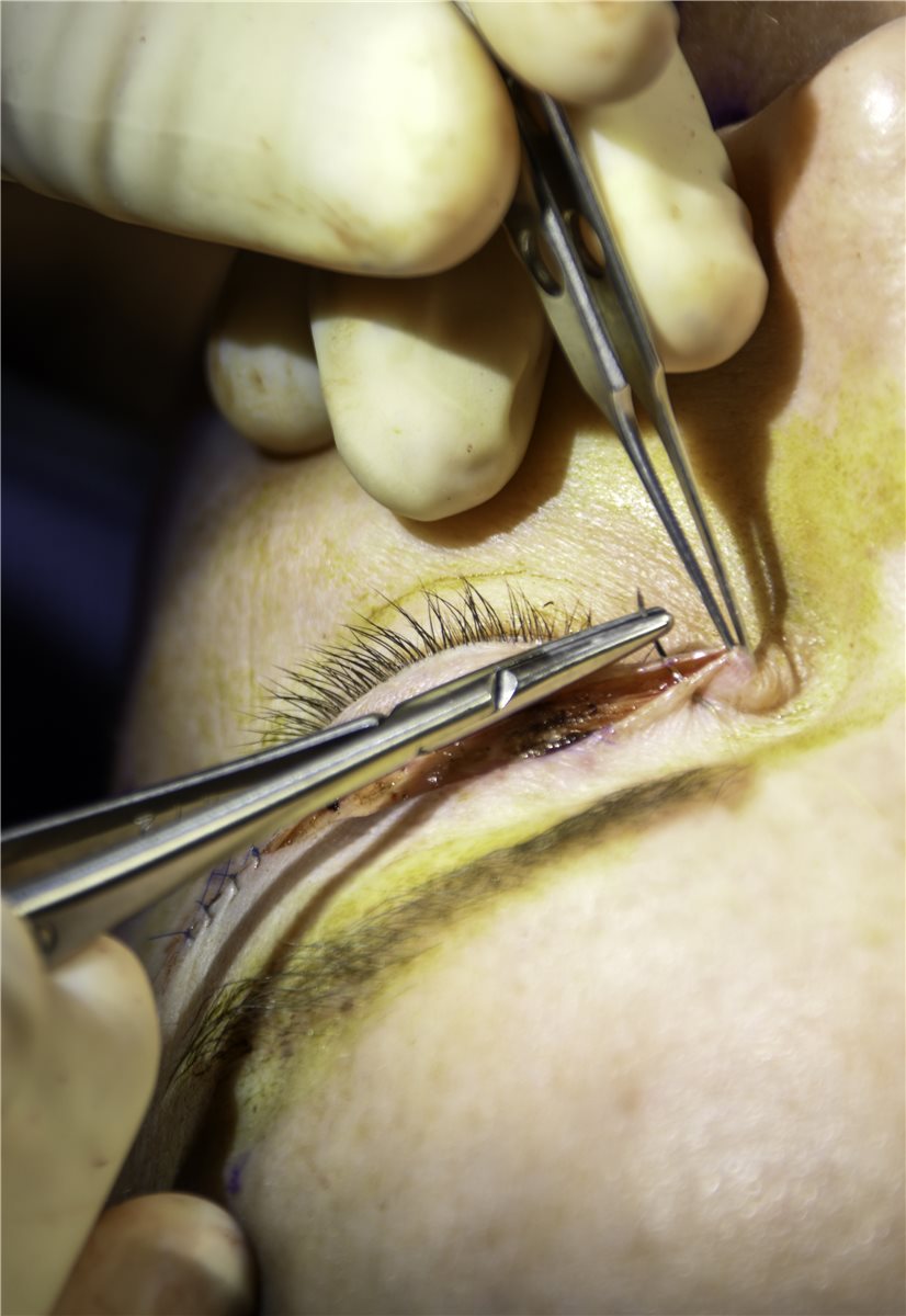 Upper eyelid blepharoplasty: an intraoperative close-up showing suture closure of the upper eyelid skin incision after excision of redundant skin and orbital fat