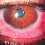 Vernal keratoconjunctivitis: a slit-lamp photograph showing gelatinous limbal thickening with conjunctival injection, typical of the limbal form of vernal keratoconjunctivitis