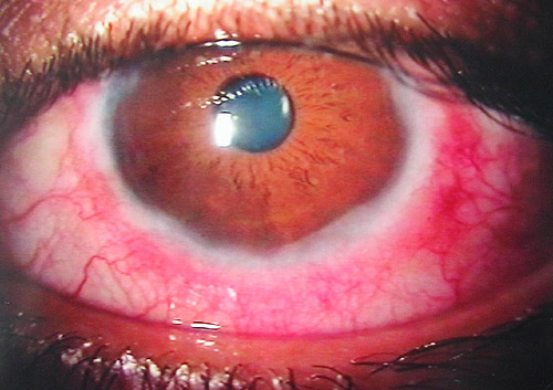 Vernal Keratoconjunctivitis: When Allergic Conjunctivitis Threatens the Cornea