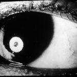 Vitamin A deficiency: foamy, keratinized Bitot spot on the temporal bulbar conjunctiva with an associated corneal opacity