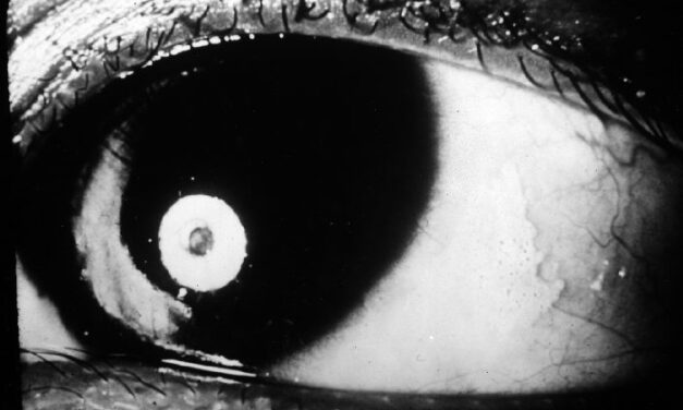 Keratomalacia: When Vitamin A Deficiency Threatens the Cornea