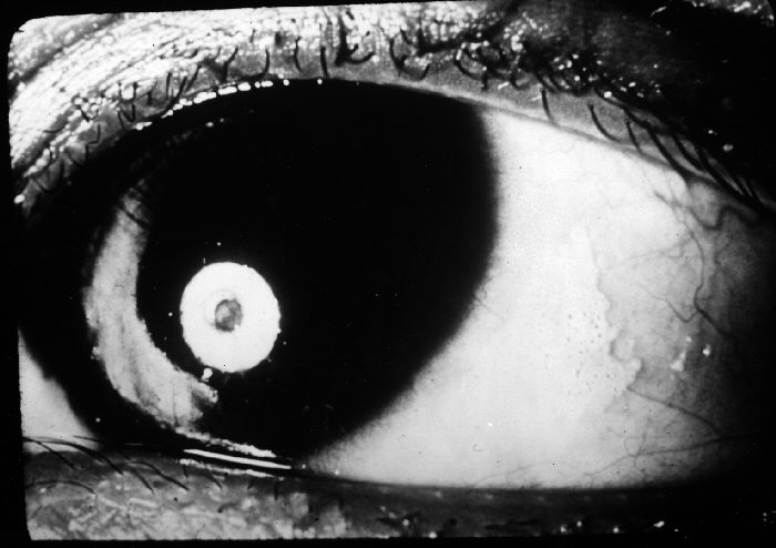 Keratomalacia: When Vitamin A Deficiency Threatens the Cornea