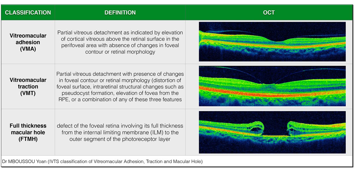 Vitreomacular traction: OCT images comparing vitreomacular adhesion, vitreomacular traction with foveal contour distortion, and a full-thickness macular hole, illustrating the IVTS classification spectrum