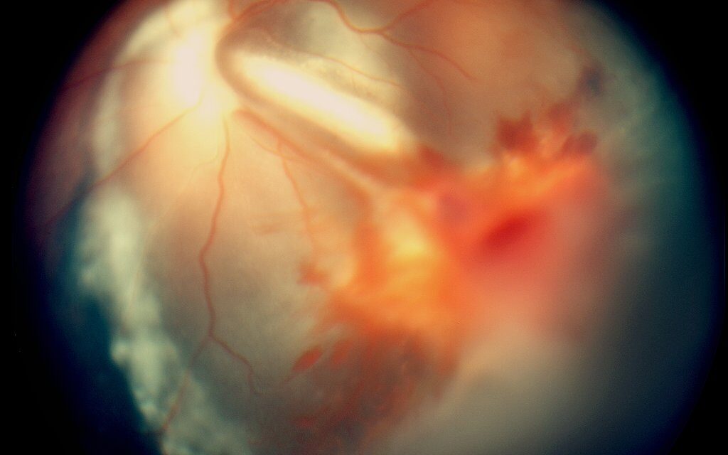 Vitreous Hemorrhage: Diagnosing Through a View You Cannot See