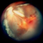 Vitreous hemorrhage: a fundus photograph showing retinal and preretinal haemorrhage with haze obscuring the underlying retinal detail