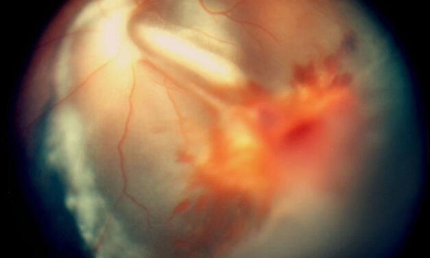 Vitreous Hemorrhage: Diagnosing Through a View You Cannot See