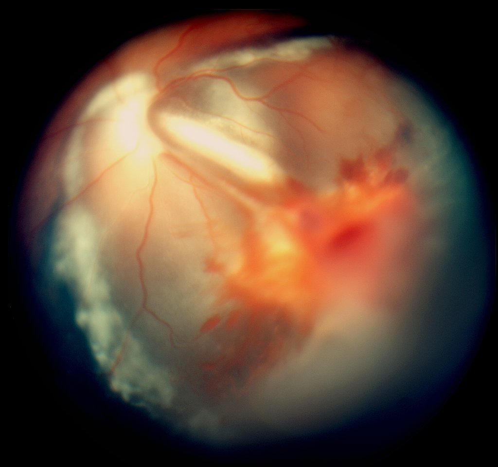 Vitreous hemorrhage: a fundus photograph showing retinal and preretinal haemorrhage with haze obscuring the underlying retinal detail