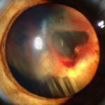 Von Hippel-Lindau disease: a slit-lamp photograph showing retinal detachment with feeder and draining vessels associated with a retinal capillary hemangioblastoma