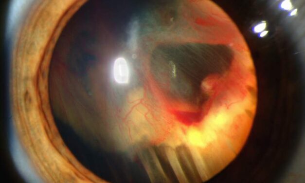 Von Hippel-Lindau Disease: When the Eye Finds the Tumour First