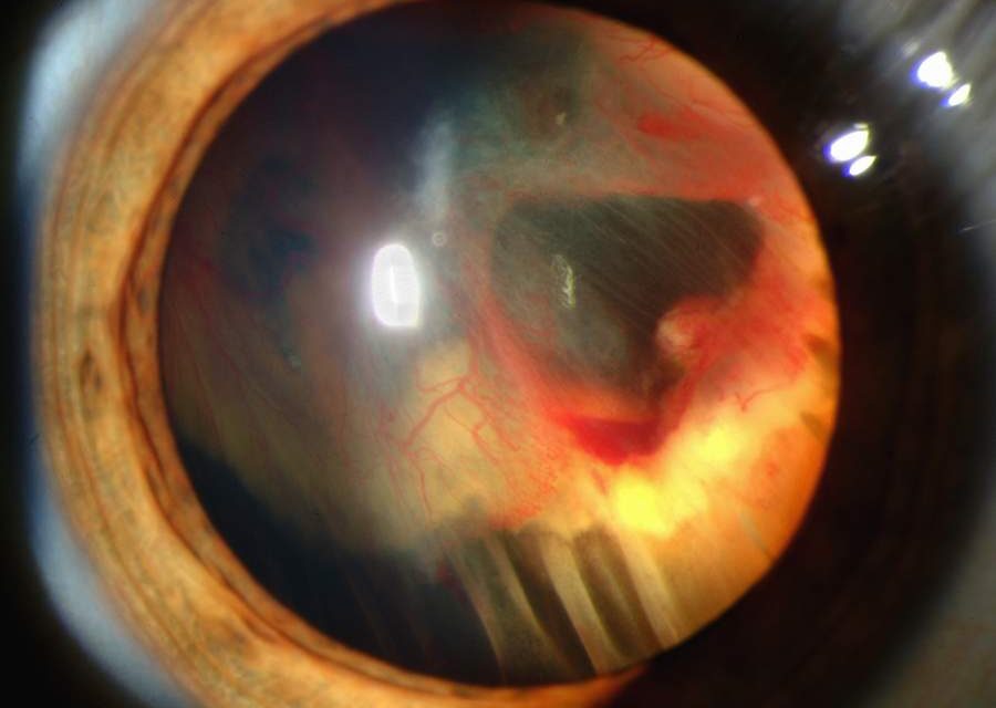 Von Hippel-Lindau Disease: When the Eye Finds the Tumour First