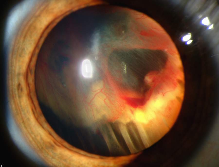 Von Hippel-Lindau disease: a slit-lamp photograph showing retinal detachment with feeder and draining vessels associated with a retinal capillary hemangioblastoma