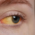Scleral Icterus