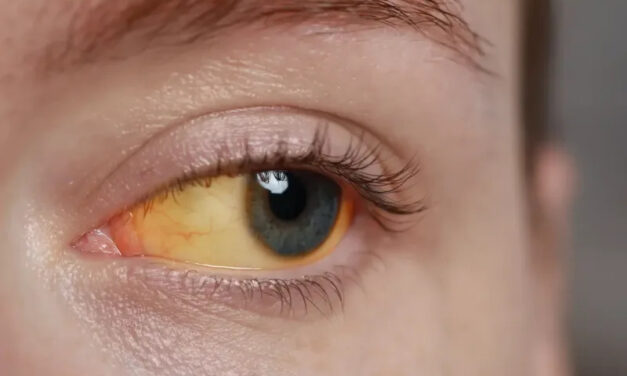 Scleral Icterus: The Eye Sign That Reveals Liver Disease