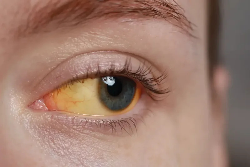 Scleral Icterus: The Eye Sign That Reveals Liver Disease