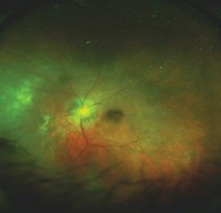Chorioretinal Biopsy