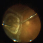 Chorioretinal Biopsy