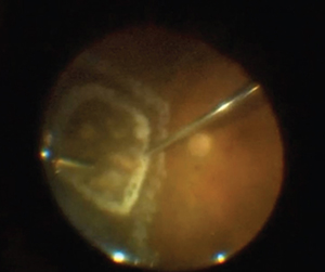 Chorioretinal Biopsy: The Diagnostic Tool of Last Resort