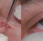 Clinical eye photograph illustrating Canalicular Laceration Repair Technique