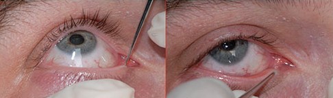 Canalicular Laceration Repair: Finding the Cut End Before It Scars Shut
