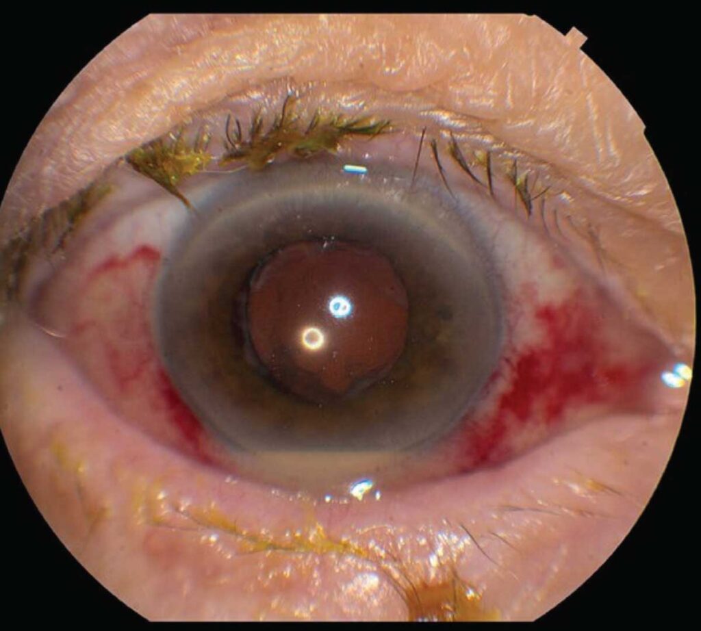 Chronic Postoperative Endophthalmitis
