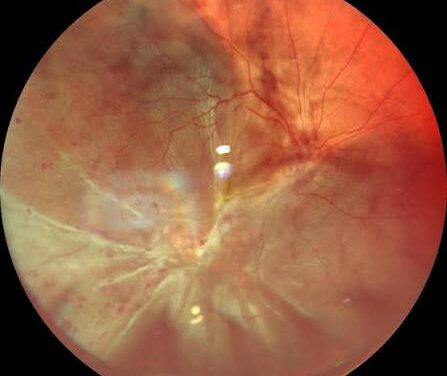 Combined Rhegmatogenous-Tractional Retinal Detachment: Two Mechanisms, One Repair