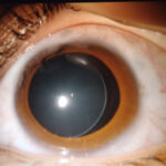 Weill-Marchesani Syndrome