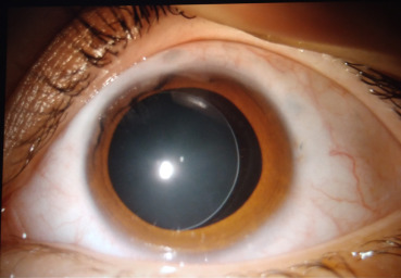 Weill-Marchesani Syndrome: Microspherophakia and the Pupillary Block Risk