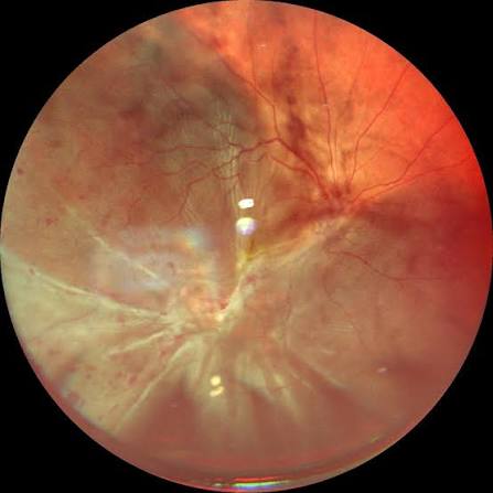 Combined Rhegmatogenous-Tractional Retinal Detachment: Two Mechanisms, One Repair
