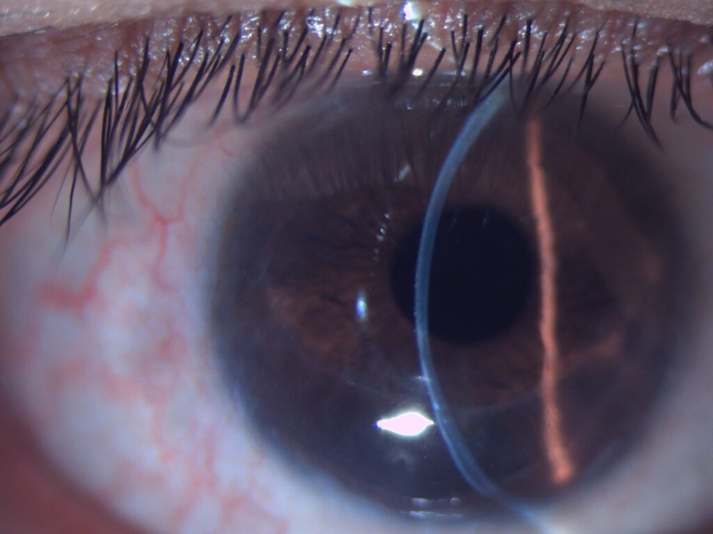 Pellucid Marginal Degeneration