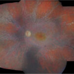 Clinical eye photograph illustrating Cancer Associated Retinopathy Recoverin