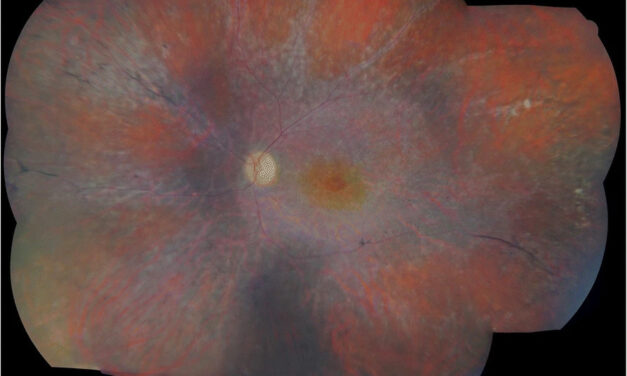 Cancer-Associated Retinopathy: A Paraneoplastic Cause of Progressive Vision Loss