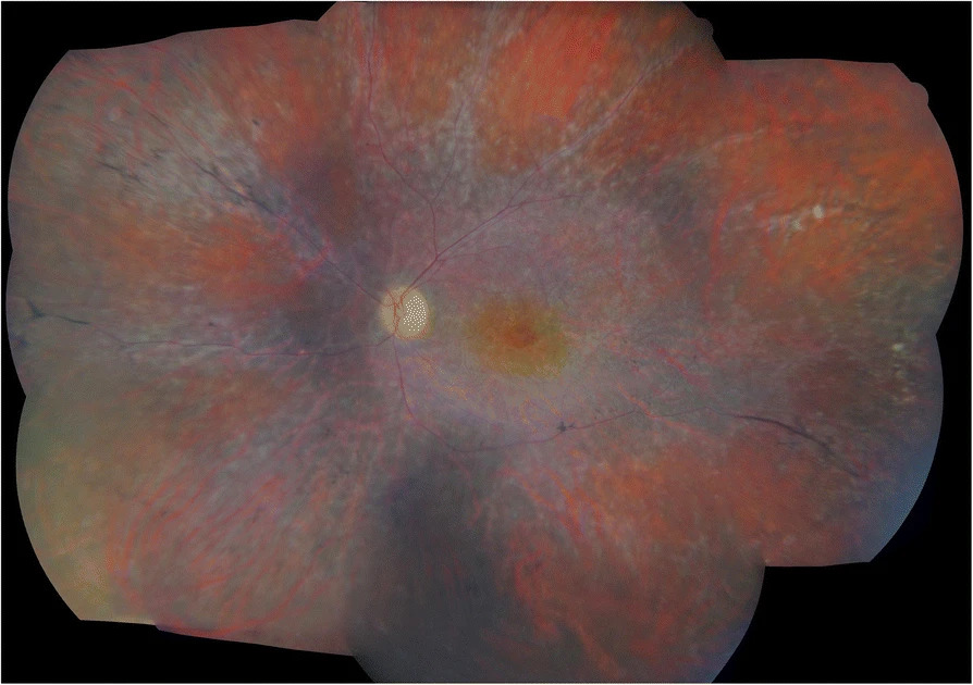Cancer-Associated Retinopathy: A Paraneoplastic Cause of Progressive Vision Loss
