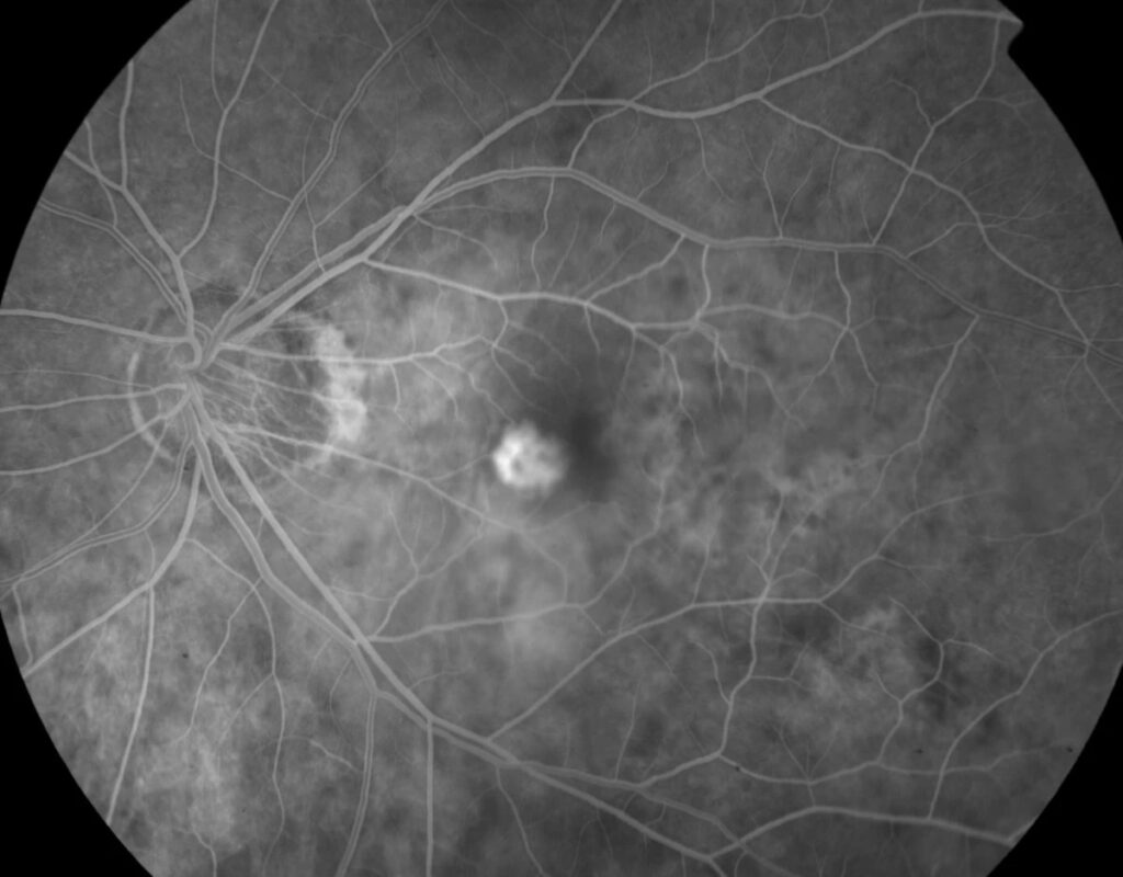 Myopic Choroidal Neovascularization