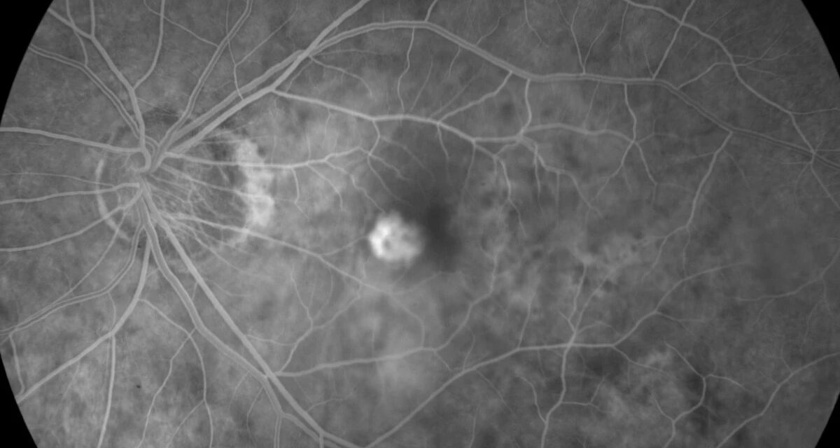 Myopic Choroidal Neovascularization: A Different Disease From AMD