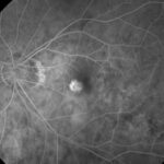 Myopic Choroidal Neovascularization